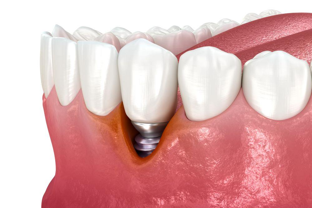 Periimplantitis