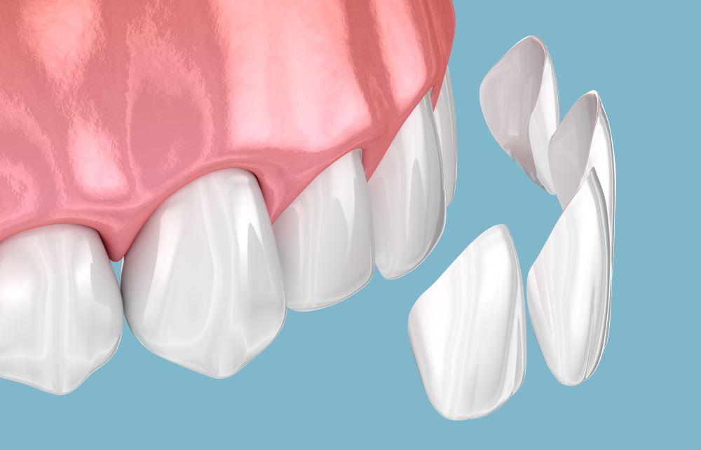 Veneers
