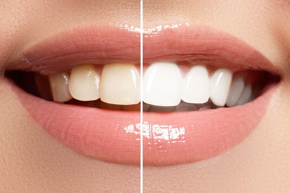 Wie lange hält ein Zahnbleaching