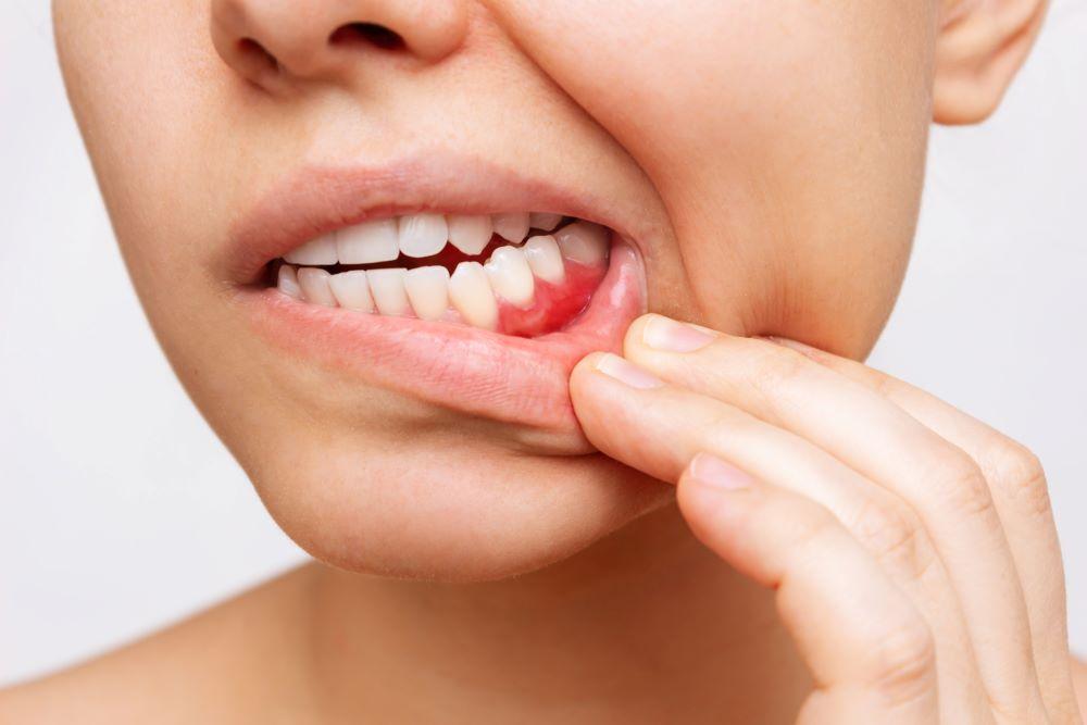 Gingivahyperplasie