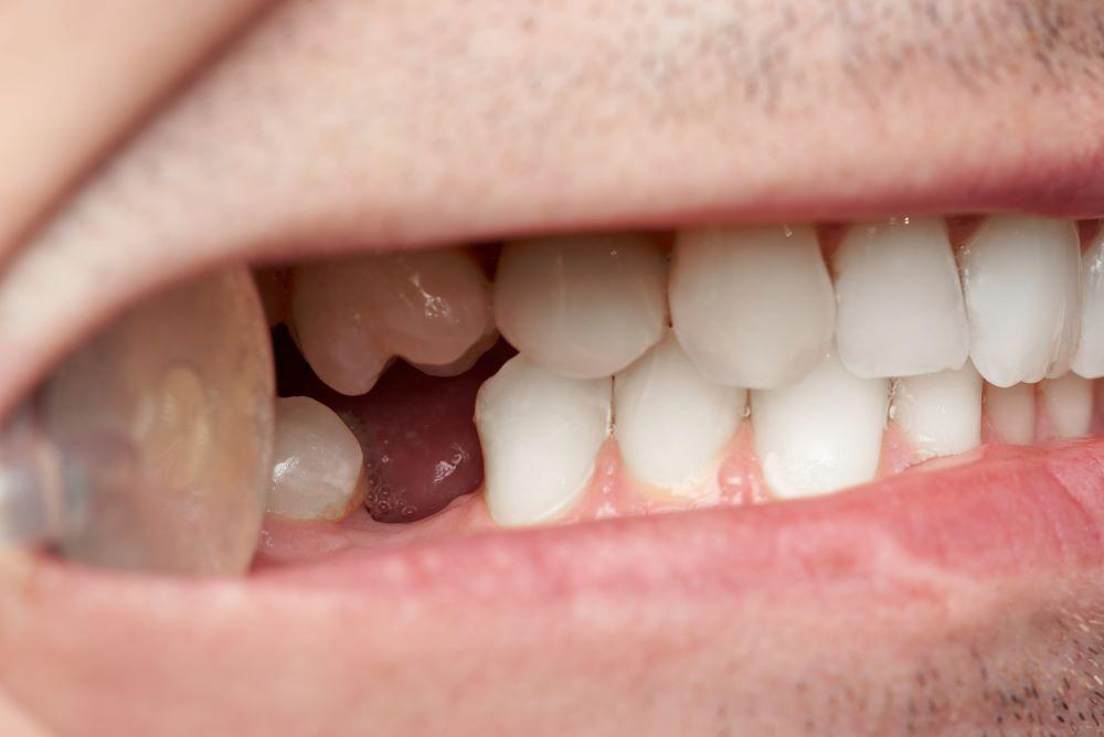 Alveolitis sicca