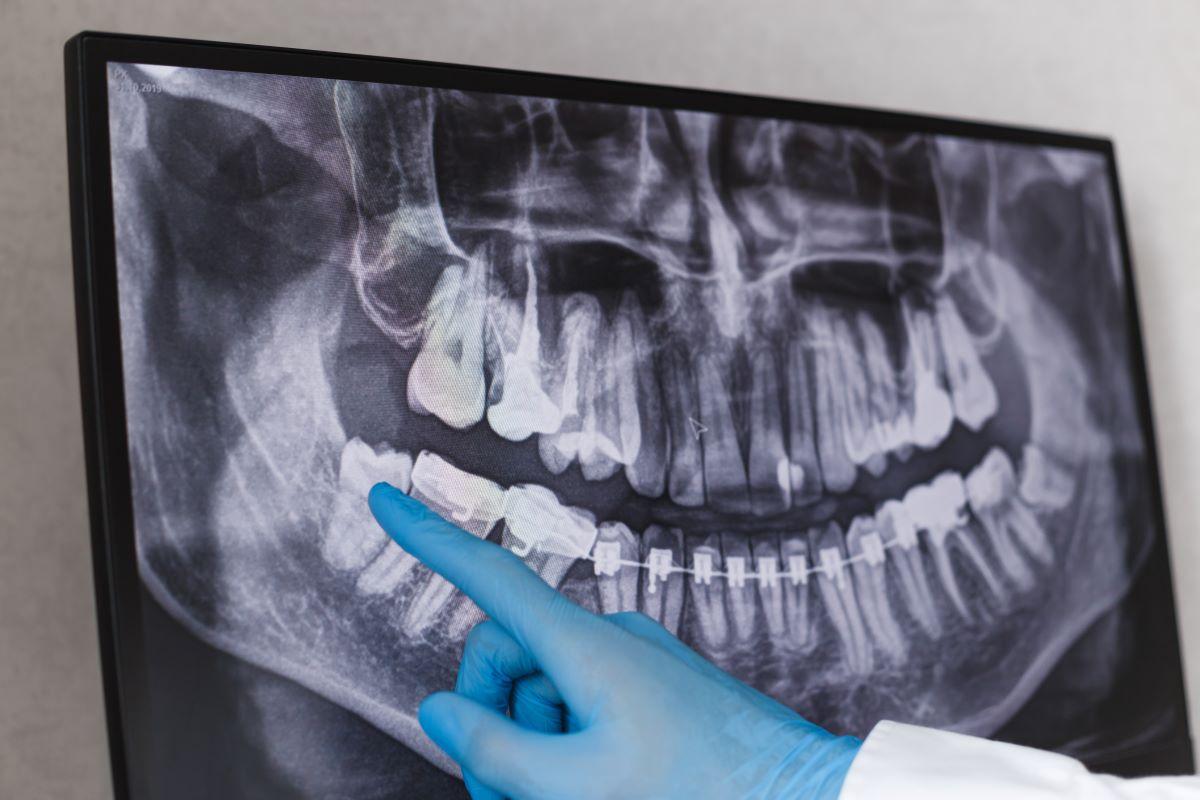 Perikoronitis