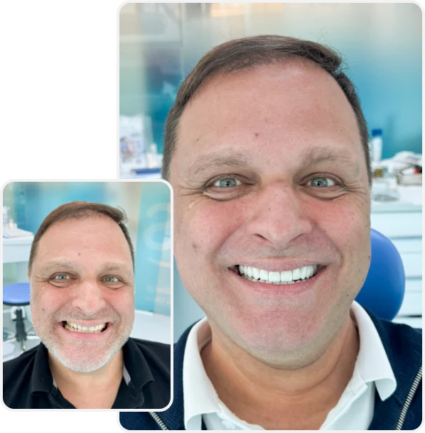 Vorher Nachher Vergleich YesSmile Patient Lars zeigt seine Zahnkronen